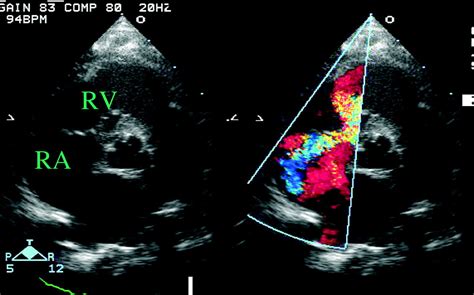 Ventricular Septal Defects Circulation