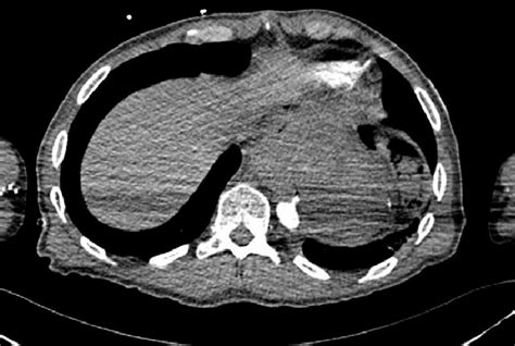 Ct Aortogram Showing The Extravasation Of Contrast Into The Stomach