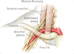 Arterial Thoracic Outlet Syndrome - The Operative Review Of Surgery