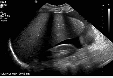 Abdominal Ultrasound US Findings The Visualized Portions Of The