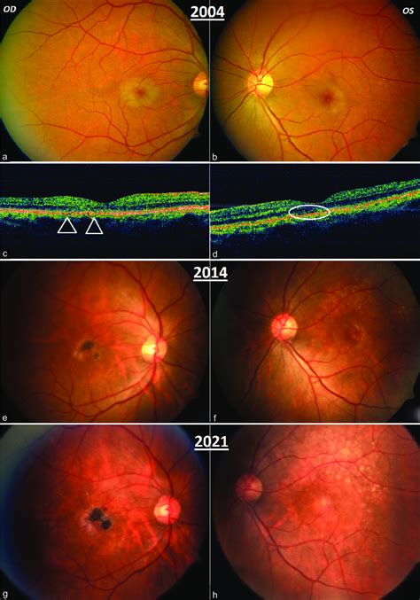 Color Fundus Photography Establishing A Diagnosis Of Type 2 Mactel With