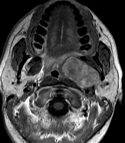 Deep lobe of parotid tumour-MRI - Sumer's Radiology Blog