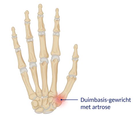 Duimbasis Artrose Pati Ntenfolder Erasmus Mc