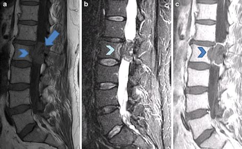 A Year Old Man With Intrathecal Catheter Tip Granuloma A Sagittal