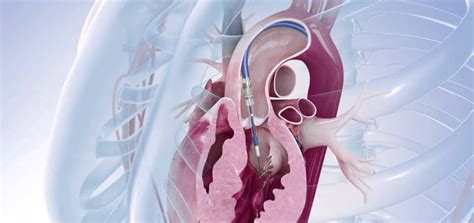 Pulmoner Kapak Ameliyat Nedir Koroner Bypass Ameliyat