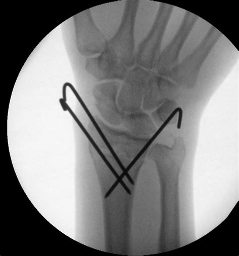 Colles Fracture Image