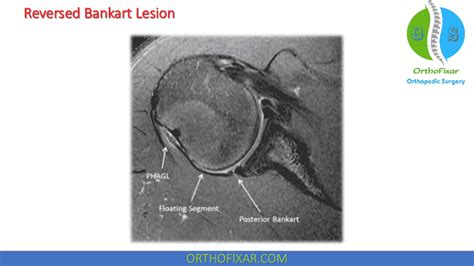 Bankart Lesion Causes Symptoms Diagnosis Treatment