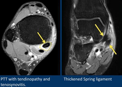 Posterior Talofibular Ligament Mri