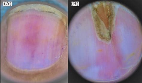 A Onychoscopy Image Showing Nail Bed Features Of Localized Download Scientific Diagram