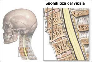 Spondiloza Cervicala Terapii Naturiste Si Tratamente