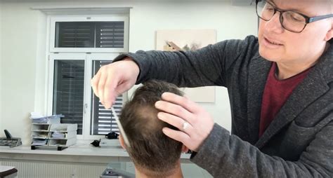 Haartransplantation Geheimratsecken Resultat Beratung Verdichtung Tonsur