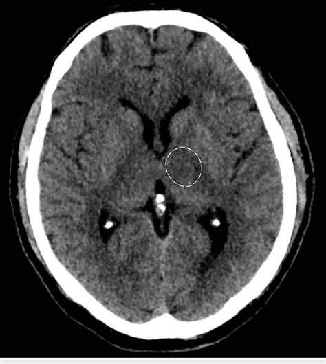 Axial Ct Scan Of The Head Demonstrating Ill Defined Hypodensity In The