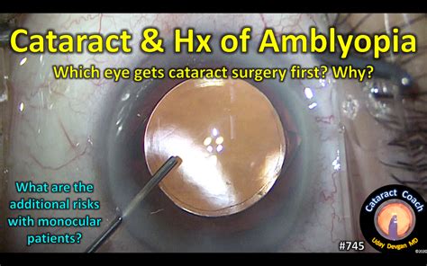 Cataract Surgery with prior Amblyopia – Cataract Coach