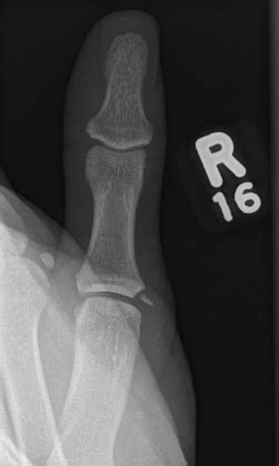 Thumb Radial Collateral Ligament The Bone School