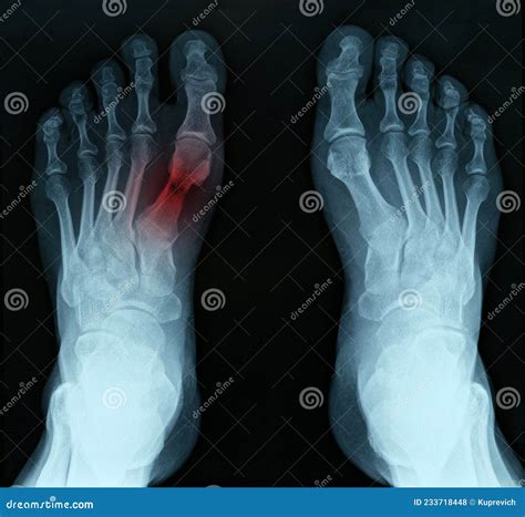 X Ray of Feet with Tarsal Fracture Closeup Stock Photo - Image of