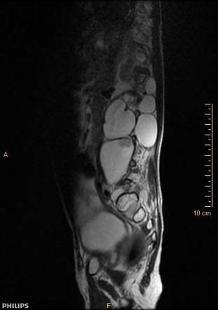 Lateral Meningocele Syndrome Radiology Case Radiopaedia Org