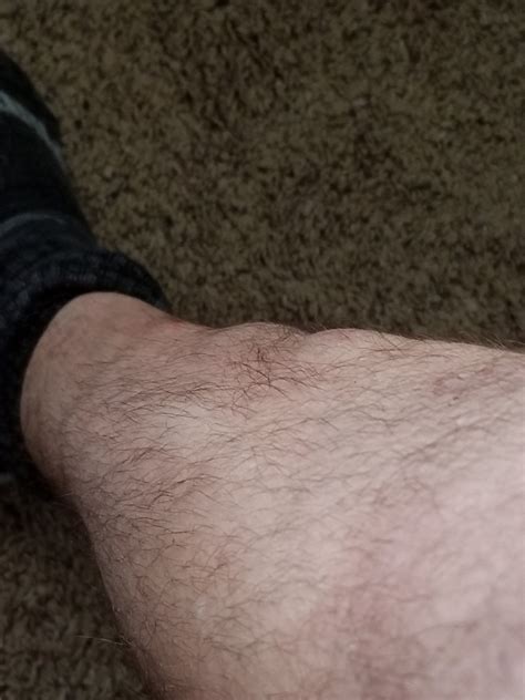 My Shin Hurts | EMTB Forums