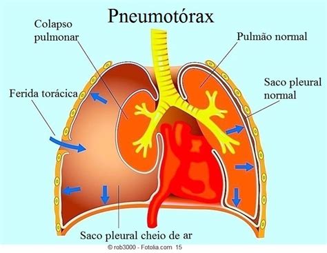 O Que Causa Pneumotorax - Pneumotórax espontâneo ou traumático, sintomas, causas e raio x