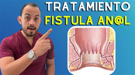 🔴 𝗙𝗜𝗦𝗧𝗨𝗟𝗔 𝗔𝗡𝗔𝗟 Síntomas Causas Y Tratamiento Youtube