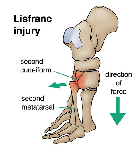 Lisfranc Fracture Dislocation - MedEd Cases