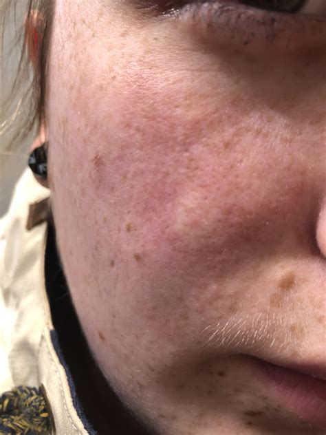 Virtual reality will soon change how new cyst popping videos look 6