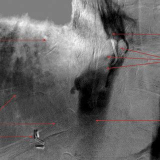 Angiogram Of Injection Of Contrast Into The Inferior Vena Cava