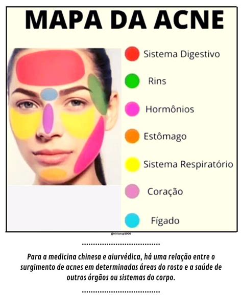 O Que É Acnes No Rosto - # Mapa da Acne | Produtos para acne, Dicas de cuidados com o rosto, Acne