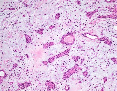 Pleomorphic Adenoma Parotid Gland Image Radiopaedia Org