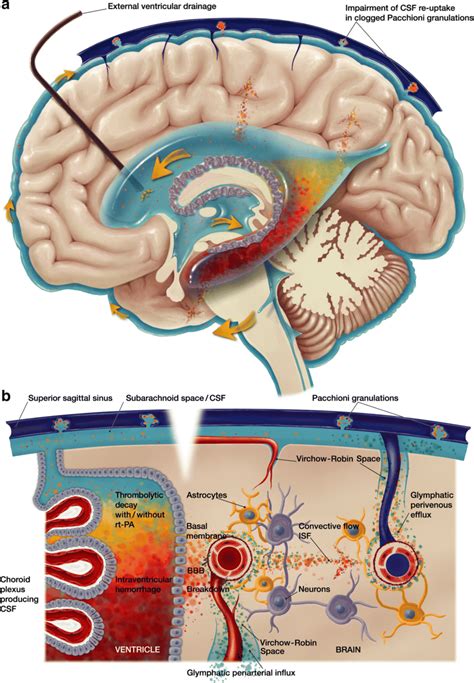 Intraventricular Hemorrhage