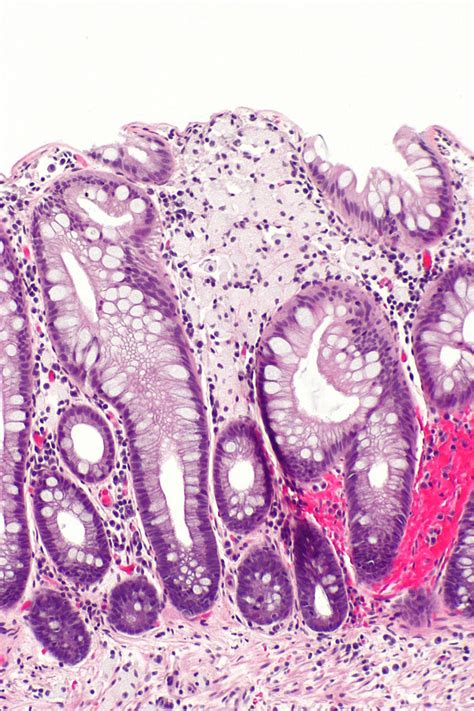 Case 62 Libre Pathology