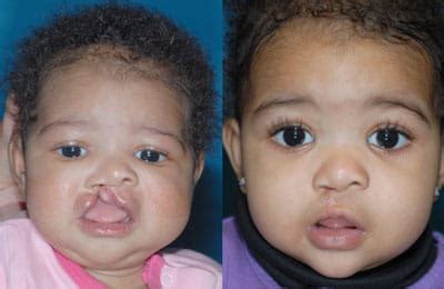 Unilateral Cleft Lip Photo Gallery | Division of Pediatric Plastic ...