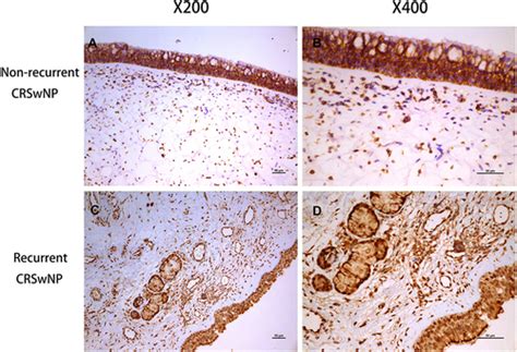 Full Article Elevated Alcam Expression Associated With Endotypes And