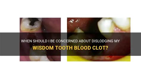 how to know if blood clot is dislodged