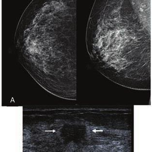 The Graphical Representation Of Age Distribution Breast Density And