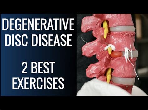 Degenerative disc disease exercises – Artofit