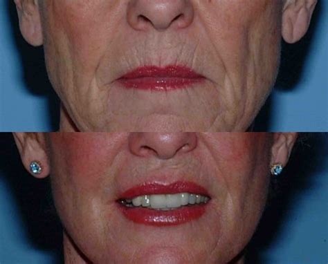 Lip Augmentation Gallery Dr Paul Vanek Md