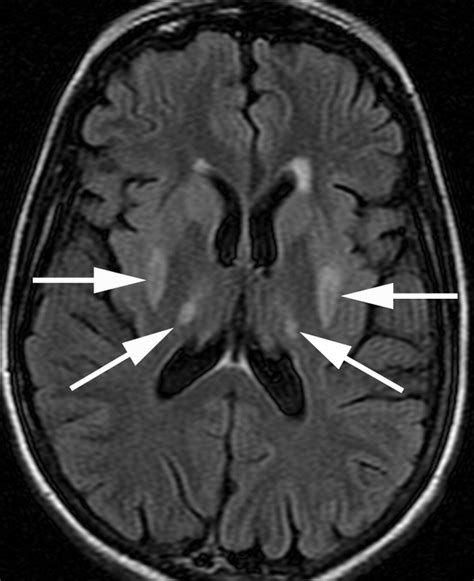 Osmotic Demyelination Syndrome Radiographics