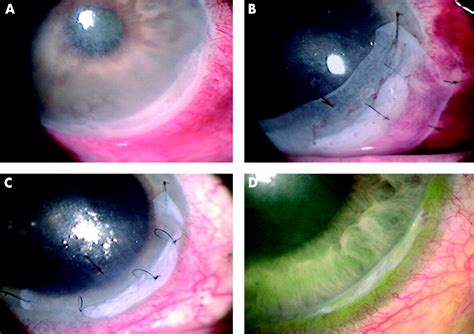 Management Of Acute Ulcerative And Necrotising Herpes Simplex And Zoster Keratitis With Amniotic