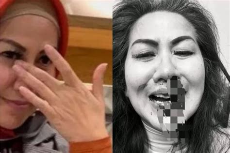 Alami KDRT Foto Venna Melinda Berlumur Darah Beredar Polda Jatim