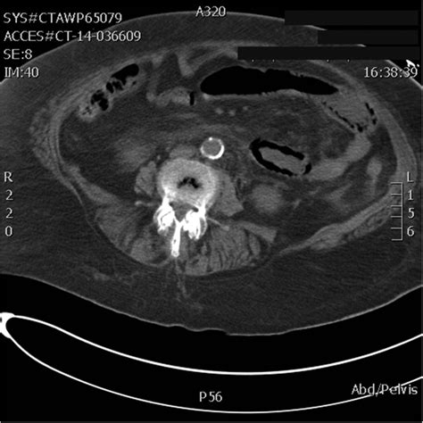 Unusual Cause Of Intussusception Bmj Case Reports