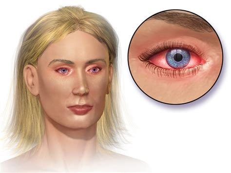 Allergic Conjunctivitis Causes Symptoms And Treatment Visionplus