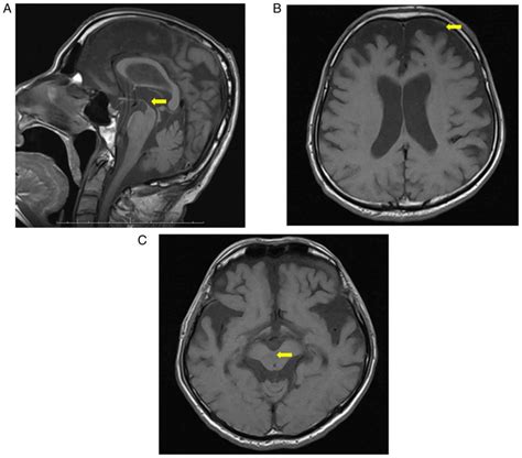 Hummingbird Sign Mri