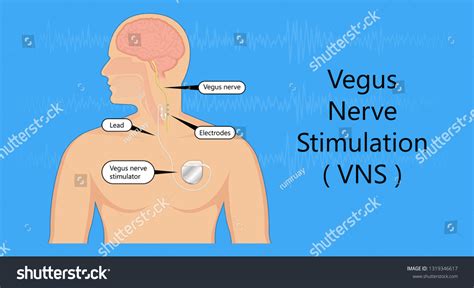 Vagus Nerve Stimulation Device Stimulate Electrical Stock Vector