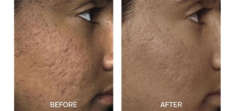 Fraxel Laser Toronto Laser Skin Resurfacing Toronto Fractional