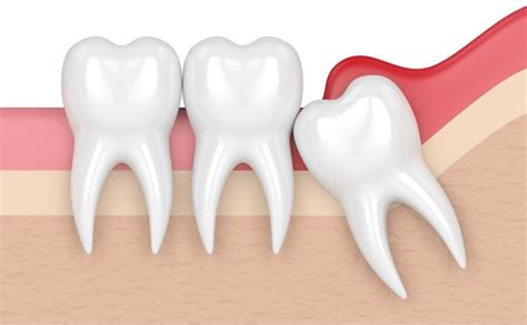wisdom teeth removal north ryde dentistry