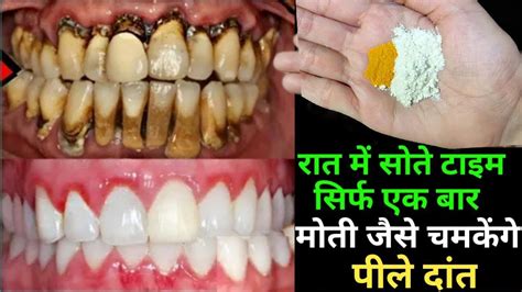 सुपारी तम्बाकू के दाग धब्बे दांतो पर से कैसे हटाएँ Teeth Whitening