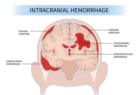 What You Need to Know About Hypovolemic Shock