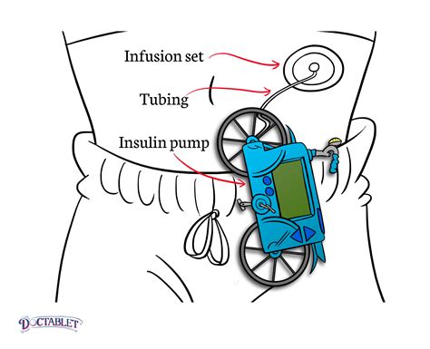 Insulin Pumps How Insulin Pumps Work Doctablet®