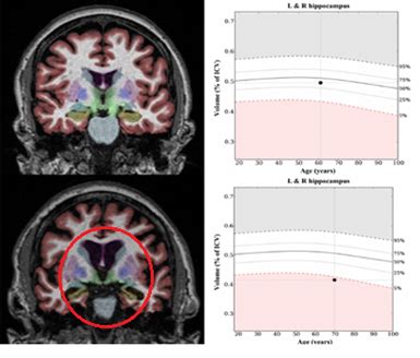 Doença de alzheimer aspectos gerais Colunistas Sanarmed