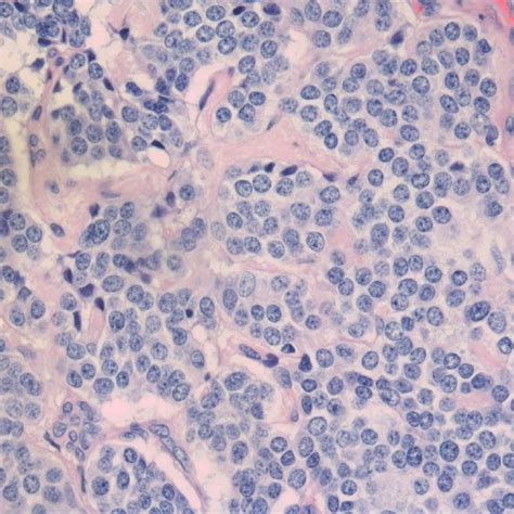 (PDF) Overview of Hurthle cell carcinoma of thyroid